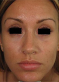 Patient # 15265 Before Photo # 1